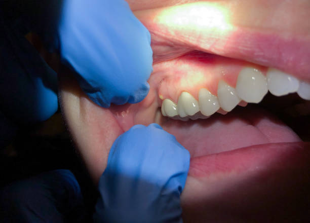 Best Broken or Chipped Tooth Repair in Locust Valley, NY